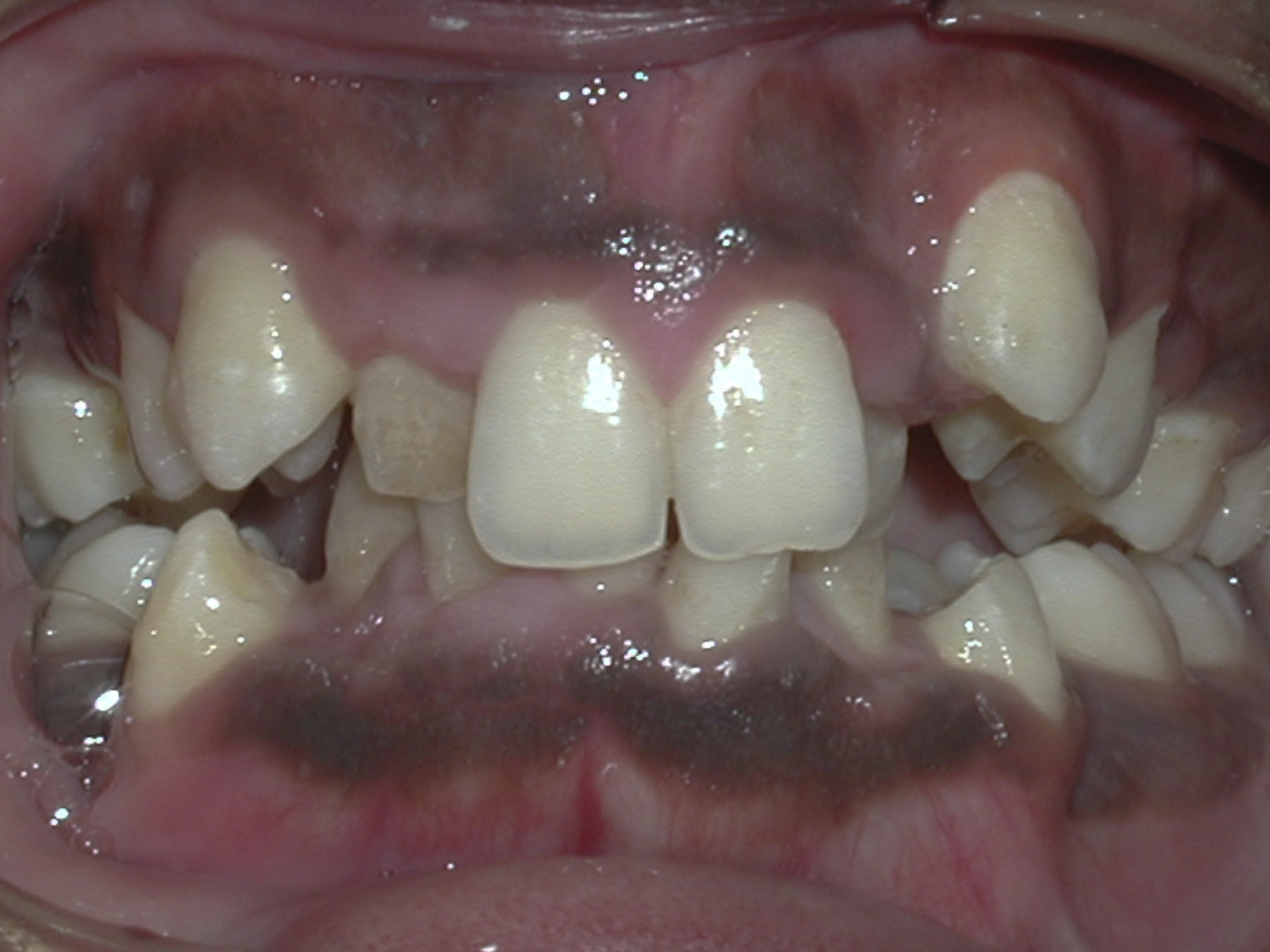 Extraction case picture 1